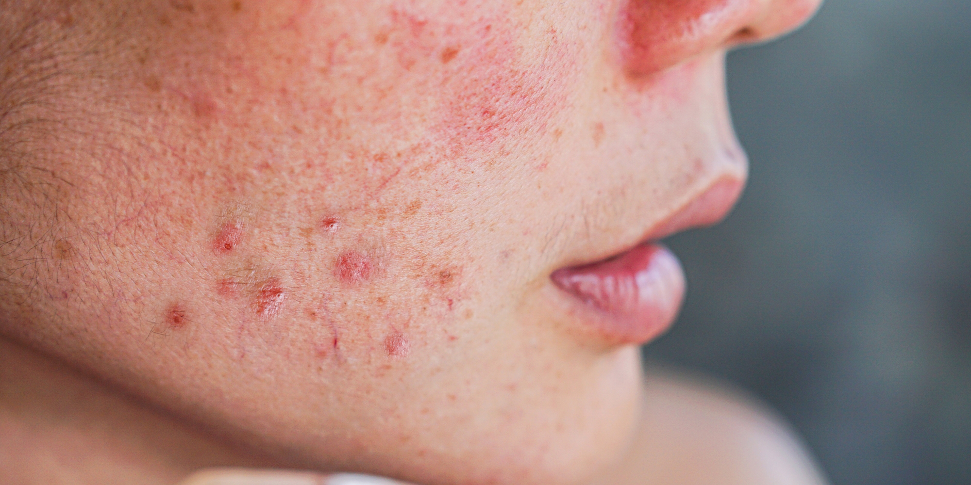 ΜΗΠΩΣ ΤΟ ΔΕΡΜΑ ΣΟΥ ΔΕΝ ΑΝΤΕΧΕΙ ΤΙΠΟΤΑ; – Blog | Skincarebc
